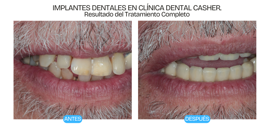 tratamiento de implantes, antes y despues