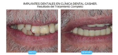 tratamiento de implantes, antes y despues