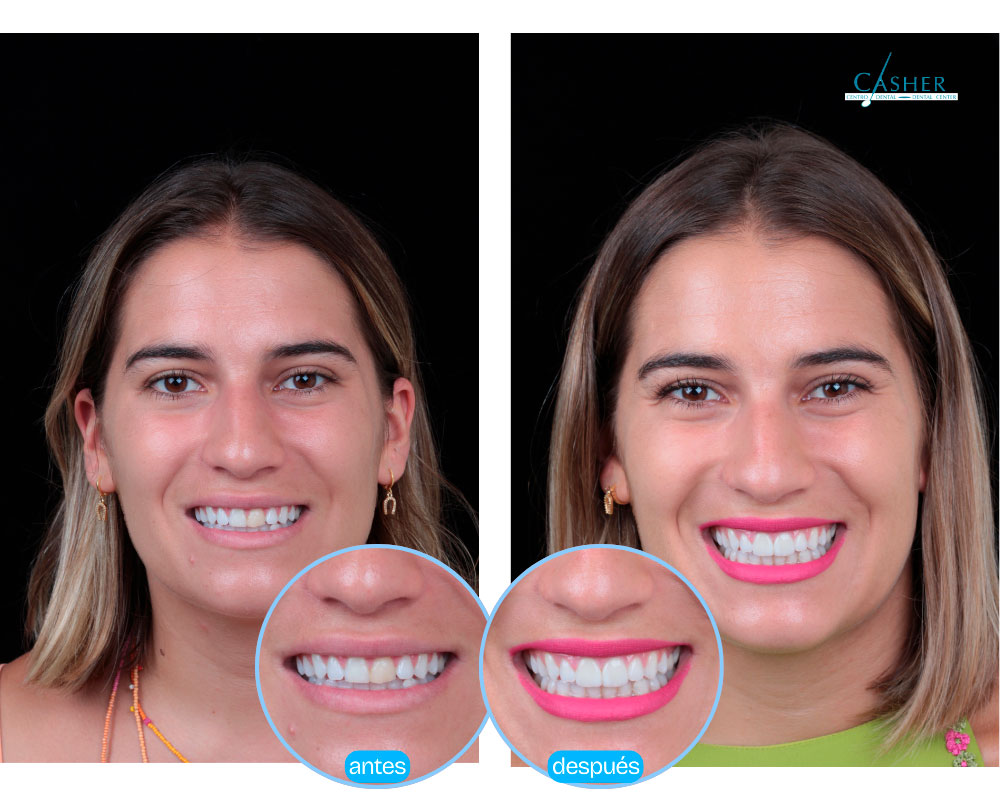 tratamiento carillas antes y despues sara