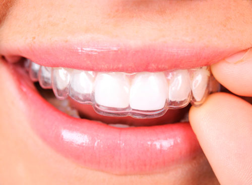 5 consejos para cuidar bien tu férula dental de descarga