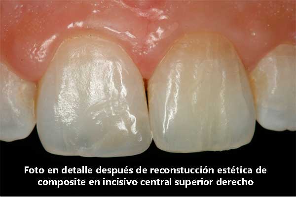 Foto en detalle después de reconstucción estética de composite en incisivo central superior derecho